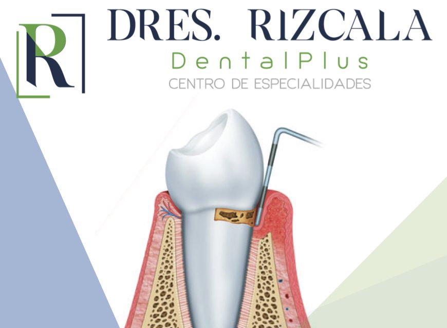 Enfermedad periodontal