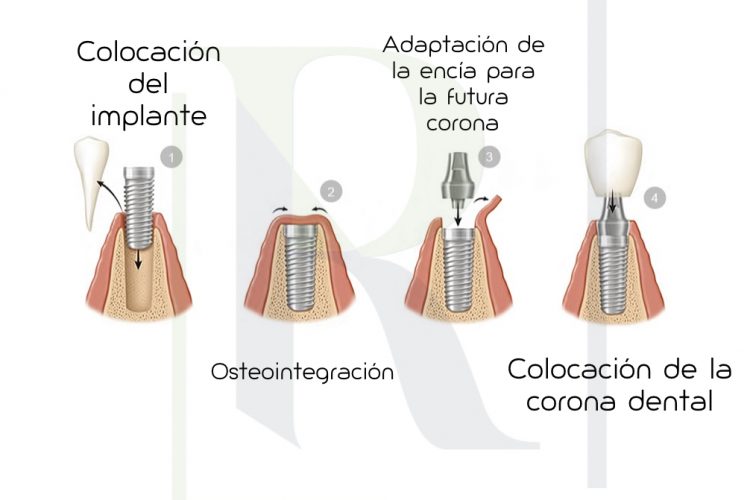Implantes dentales Maracena Vélez Málaga