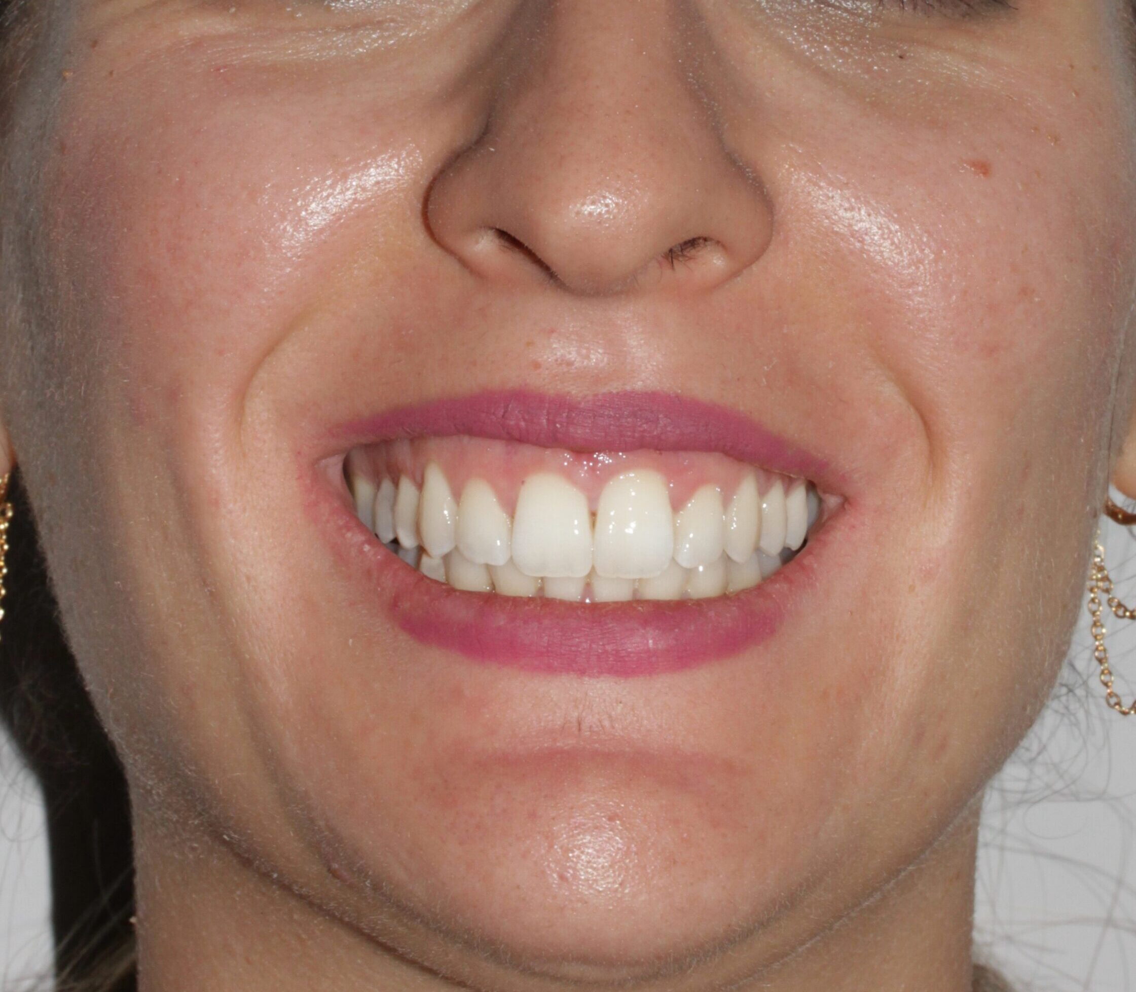 Sonrisa perfecta tras tratamiento de Ortodoncia